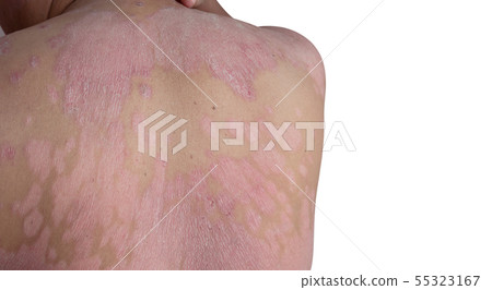 Close up the shoulder ulcers and back 55323167