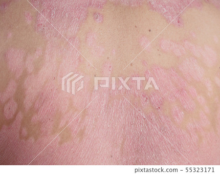Close up flakes on the back 55323171