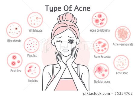 skin care type of acne skin care type of acne 55334762