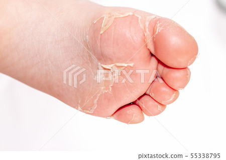 After the red rash and the strawberry tongue caused by scarlet fever the affected skin often peels - After the red rash and the strawberry tongue caused by scarlet fever the affected skin often peels - 55338795