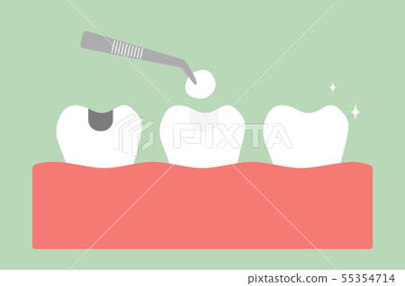 tooth amalgam filling with dental tools tooth amalgam filling with dental tools 55354714