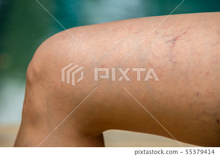 Varicose veins on the thigh and legs in woman 55379414