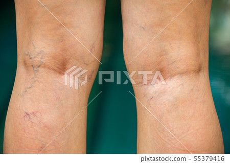 Varicose veins on the back of knee, leg in woman Varicose veins on the back of knee, leg in woman 55379416