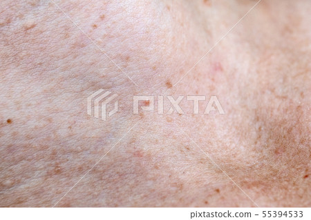 Skin pigmentation. Moles and freckles Skin pigmentation. Moles and freckles 55394533