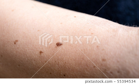 Skin pigmentation. Moles and freckles Skin pigmentation. Moles and freckles 55394534