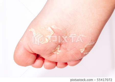 After the red rash and the strawberry tongue caused by scarlet fever the affected skin often peels - 55417072