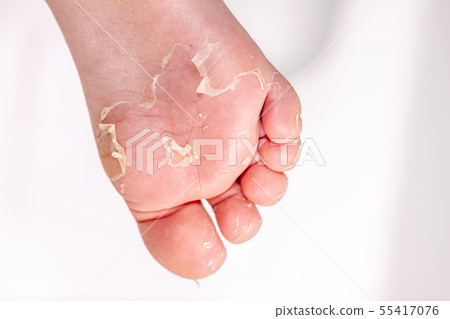 After the red rash and the strawberry tongue caused by scarlet fever the affected skin often peels - 55417076