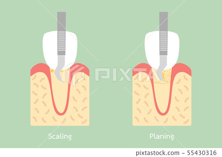 teeth scaling - dental plaque removal teeth scaling - dental plaque removal 55430316