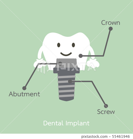 structure of the dental implant with all parts 55461946
