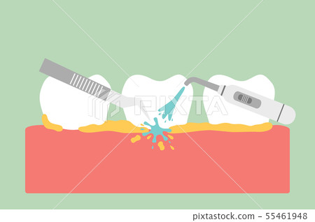 teeth scaling, dental plaque removal for cleaning teeth scaling, dental plaque removal for cleaning 55461948