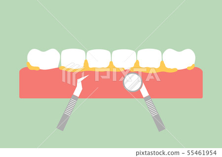 teeth scaling, dental plaque removal for cleaning 55461954