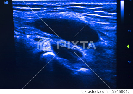 EPI dry needling ultrasound scan 55468042