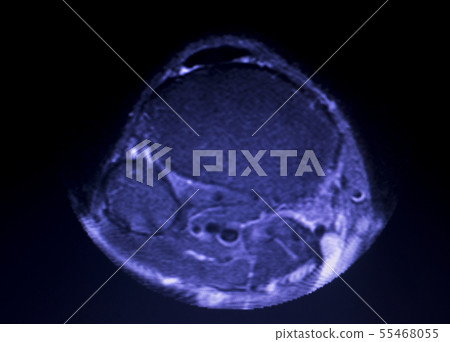 MRI knee meniscus tear scan MRI knee meniscus tear scan 55468055