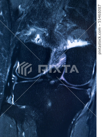 Knee injury mri mcl tear Knee injury mri mcl tear 55468087