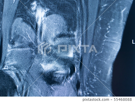Knee injury mri mcl tear Knee injury mri mcl tear 55468088