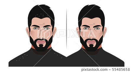 Man with dandruff falling on his shoulders 55485658