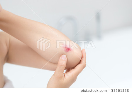 傷痕 劃傷 肘部 55561358
