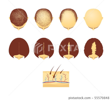 Set of male and female heads in top view with hair loss cartoon style Set of male and female heads in top view with hair loss cartoon style 55570848