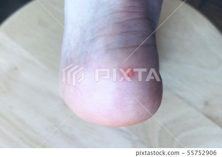 Dermatitis Skin trouble Rough skin Eczema Insect bites Case 10 55752906