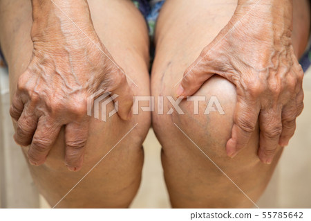 Senior woman suffering from knees pain Senior woman suffering from knees pain 55785642