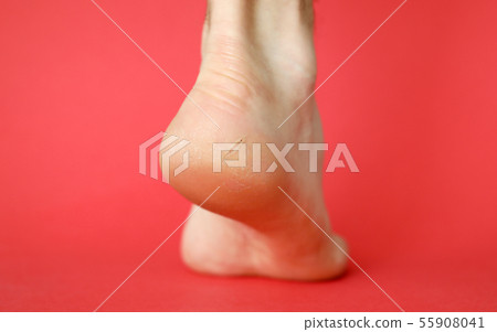 Heel with a cracked skin disease on a red 55908041