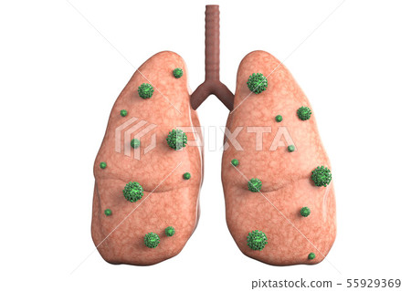 lung disease with bacteria cells lung disease with bacteria cells 55929369