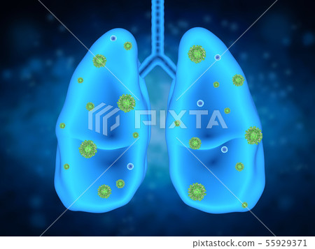 lung disease with bacteria cells 55929371