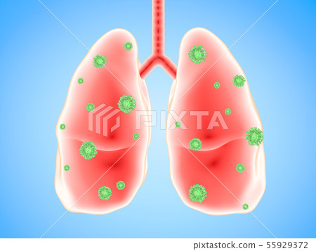 lung disease with bacteria cells lung disease with bacteria cells 55929372