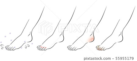 Female feet athlete's foot 55955179