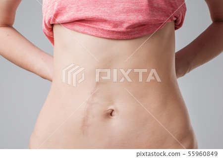 European woman with long abdominal scars after operation European woman with long abdominal scars after operation 55960849