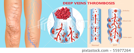 Deep Vein Thrombosis or Blood Clots. Embolus. 55977264