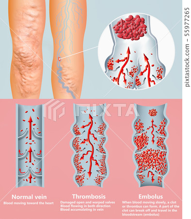 Deep Vein Thrombosis or Blood Clots. Embolus. 55977265
