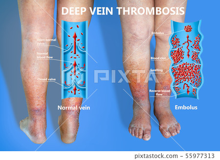 Close-up of skin with varicose veins Close-up of skin with varicose veins 55977313