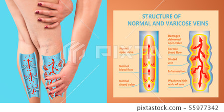 Varicose veins on a female senior legs. The structure of normal and varicose veins. Varicose veins on a female senior legs. The structure of normal and varicose veins. 55977342