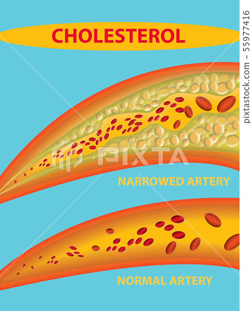 Blocked blood vessel - artery with cholesterol Blocked blood vessel - artery with cholesterol 55977416