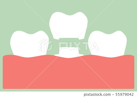 dental crown, install process and change of teeth 55979042