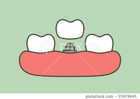 tooth implant, install process and change new root 55979045