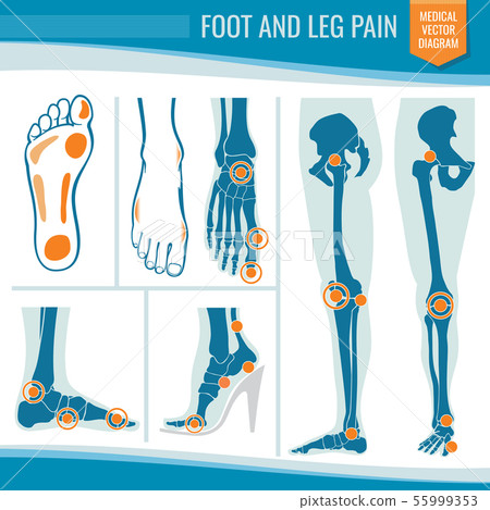 Foot and leg pain. Arthritis and rheumatism orthopedic medical vector diagram 55999353