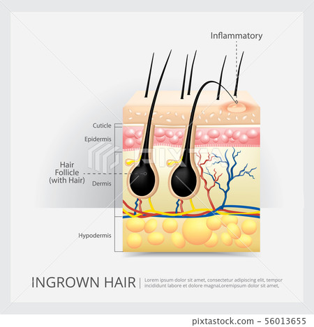 Ingrown Hair Structure Vector Illustration 56013655