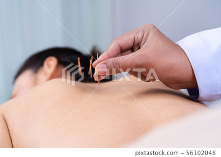 woman undergoing acupuncture treatment on back woman undergoing acupuncture treatment on back 56102048