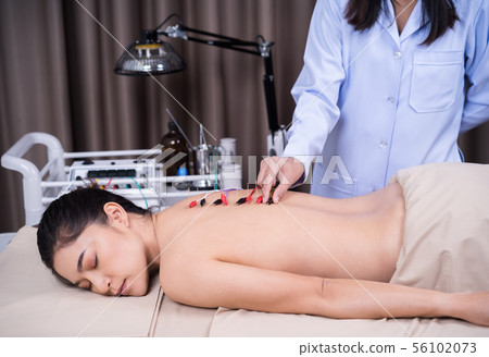 woman undergoing acupuncture treatment with 56102073