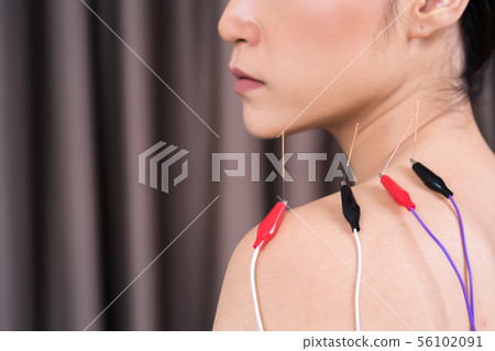 woman undergoing acupuncture treatment with woman undergoing acupuncture treatment with 56102091