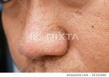 acne vulgaris on nose of asian man acne vulgaris on nose of asian man 56102666