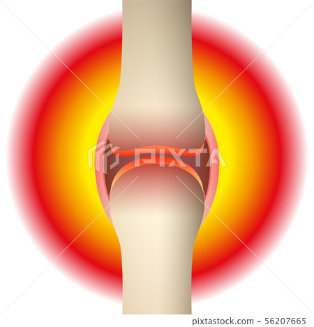 Joint Pain Rheumatism Synovial Joint Joint Pain Rheumatism Synovial Joint 56207665