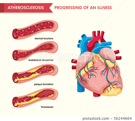 Scientific medical illustration of atherosclerosis 56244664