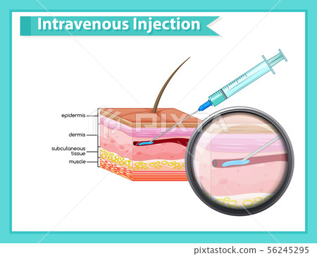 Scientific medical illustration of intravenous Scientific medical illustration of intravenous 56245295