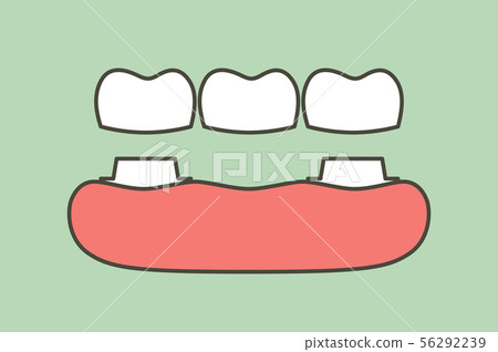 dental crown with bridge 56292239