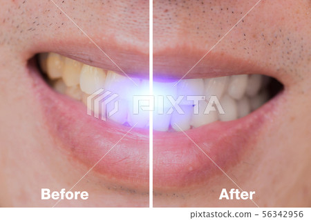 Before and After of dental bleaching in male Before and After of dental bleaching in male 56342956