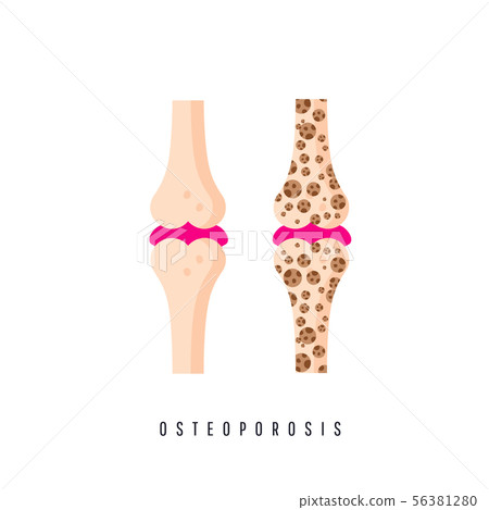 Two bones are normal and sore. Osteoporosis bone Two bones are normal and sore. Osteoporosis bone 56381280
