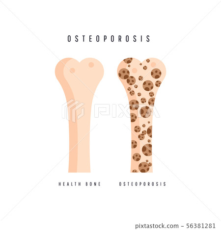 Illustration of osteoporosis bone and healthy 56381281